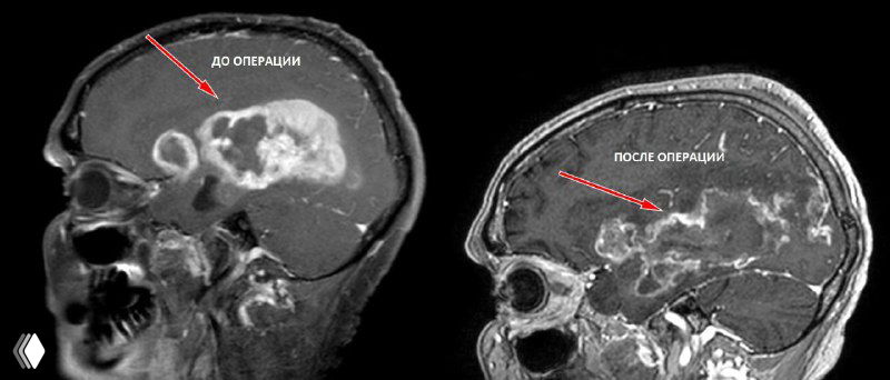 Сагиттальный МРТ с отметками «до операции» и «после операции»: массивная глиобластома, практически заполняющая более половины правого полушария головного мозга.