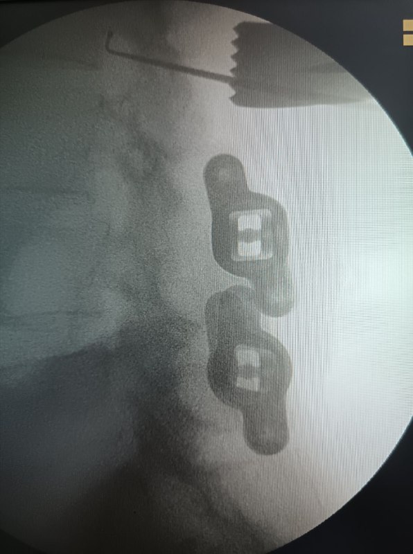 Стеноз выше имплантов межостистой фиксации Ромео