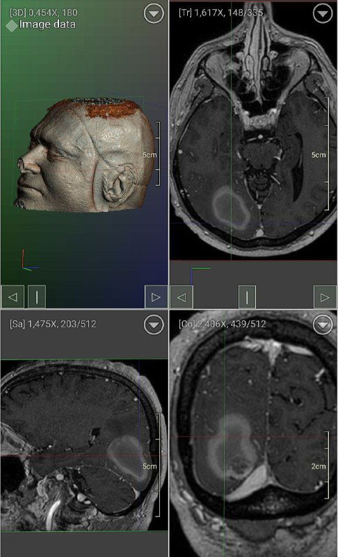 Кавернома после кровоизлияния: парадокс и тактика