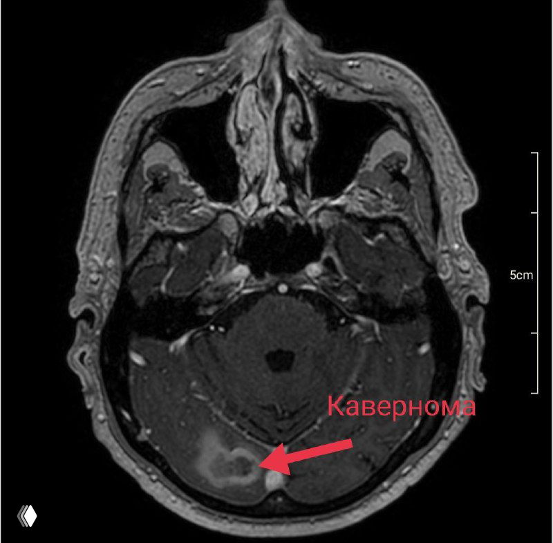 Аксиальный МРТ‑срез задней черепной ямки, стрелкой отмечена кавернома в области мозжечка и нижних структур задней ямки.