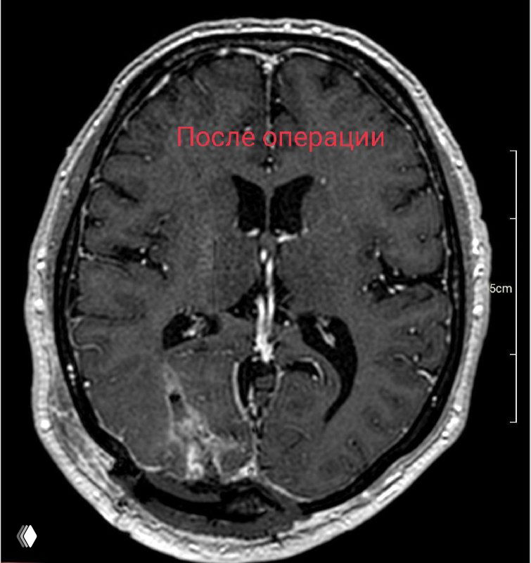 Аксиальный контрастный МРТ‑срез головного мозга после операции; видны зоны постоперационной контрастировки и удалённая кавернома.
