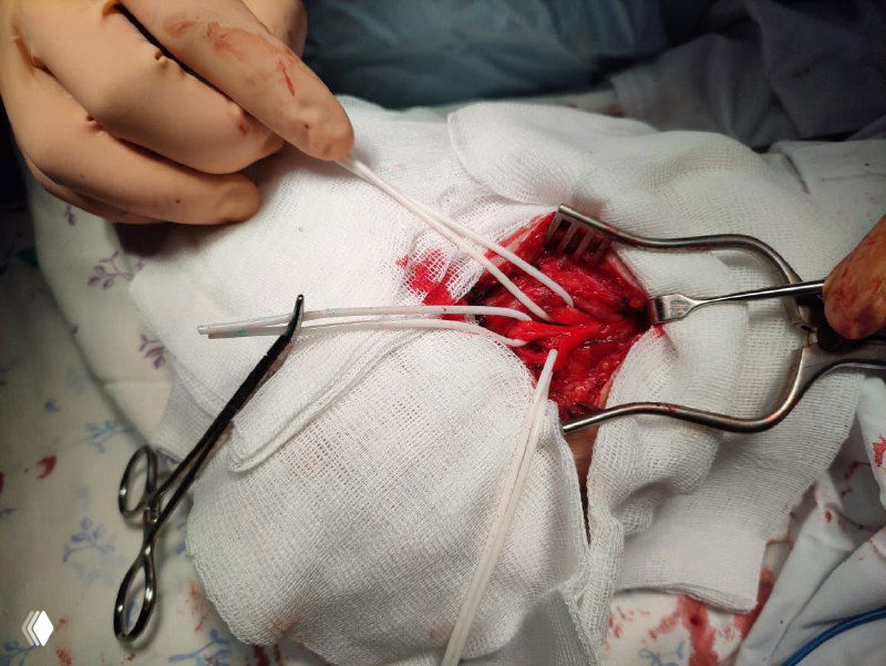 Поражение большеберцового нерва