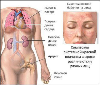 Системная красная волчанка: кейс терапии МПТ