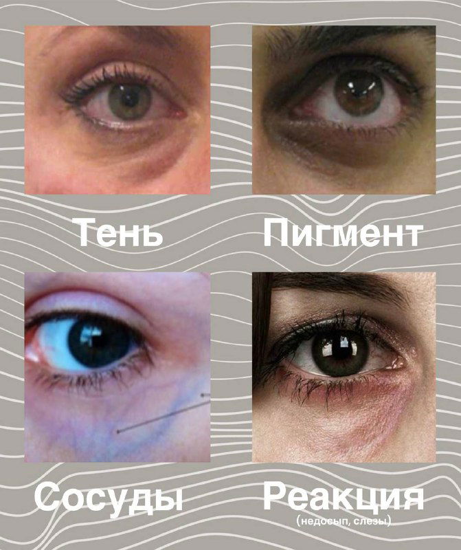 Тёмные круги под глазами: причины и что помогает