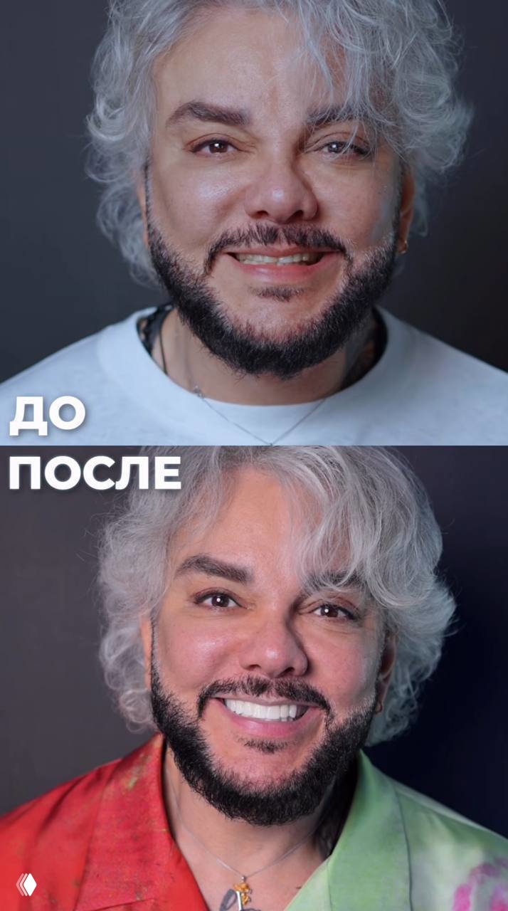 Новые виниры Филиппа Киркорова