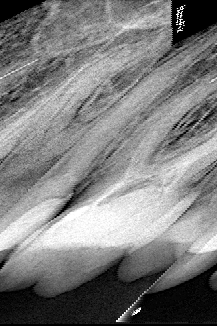 Обломок в корневом канале: байпас и решение