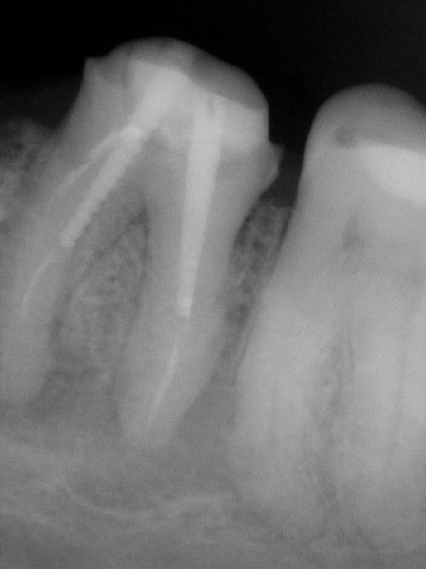 Идеальная эндодонтия существует только в Instagram