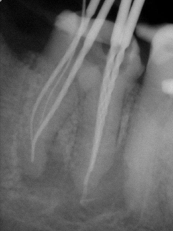 Интраоральный снимок с рабочими файлами в корневых каналах и инструментами, демонстрирующий длину и конфигурацию корней в процессе лечения.