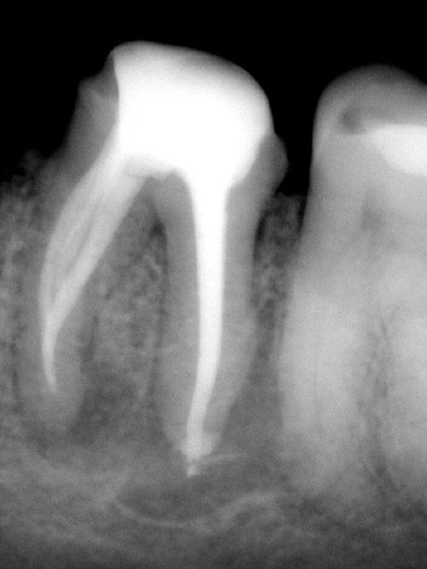 Контрольный рентген после эндодонтической обработки: запломбированные каналы и положение анкерного штифта, обзор апикальной зоны после вмешательства.