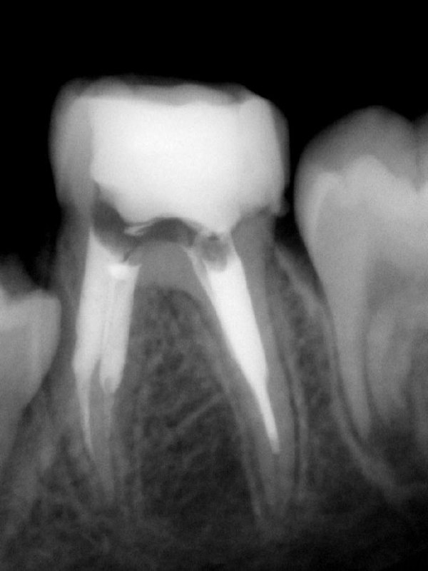 После метапекса — не эпоксидный силер