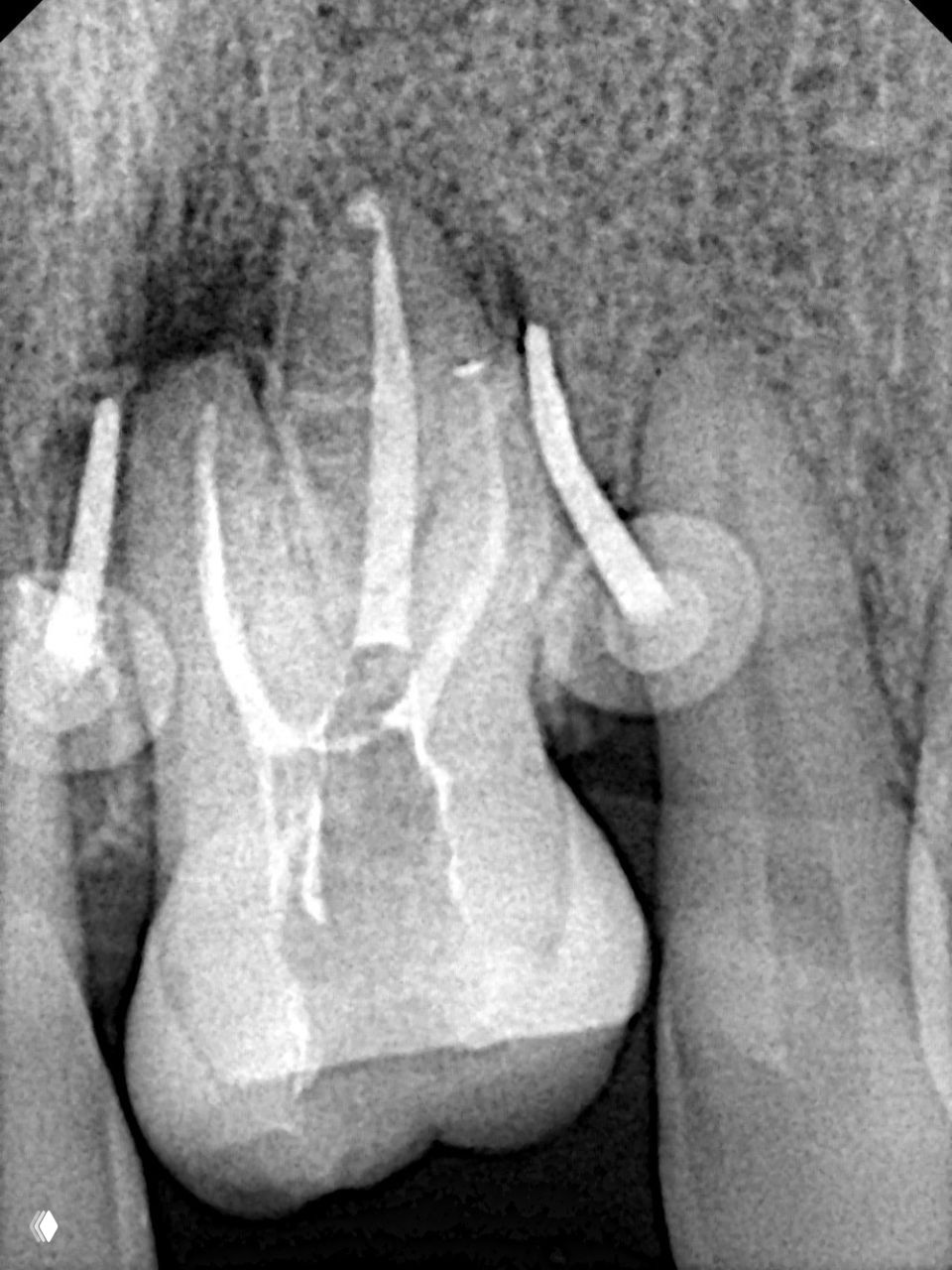 Рентгенограмма во время эндодонтического лечения: видно раскрытые корневые каналы с инструментами и заполнение верхних отделов каналов во время обтурации.