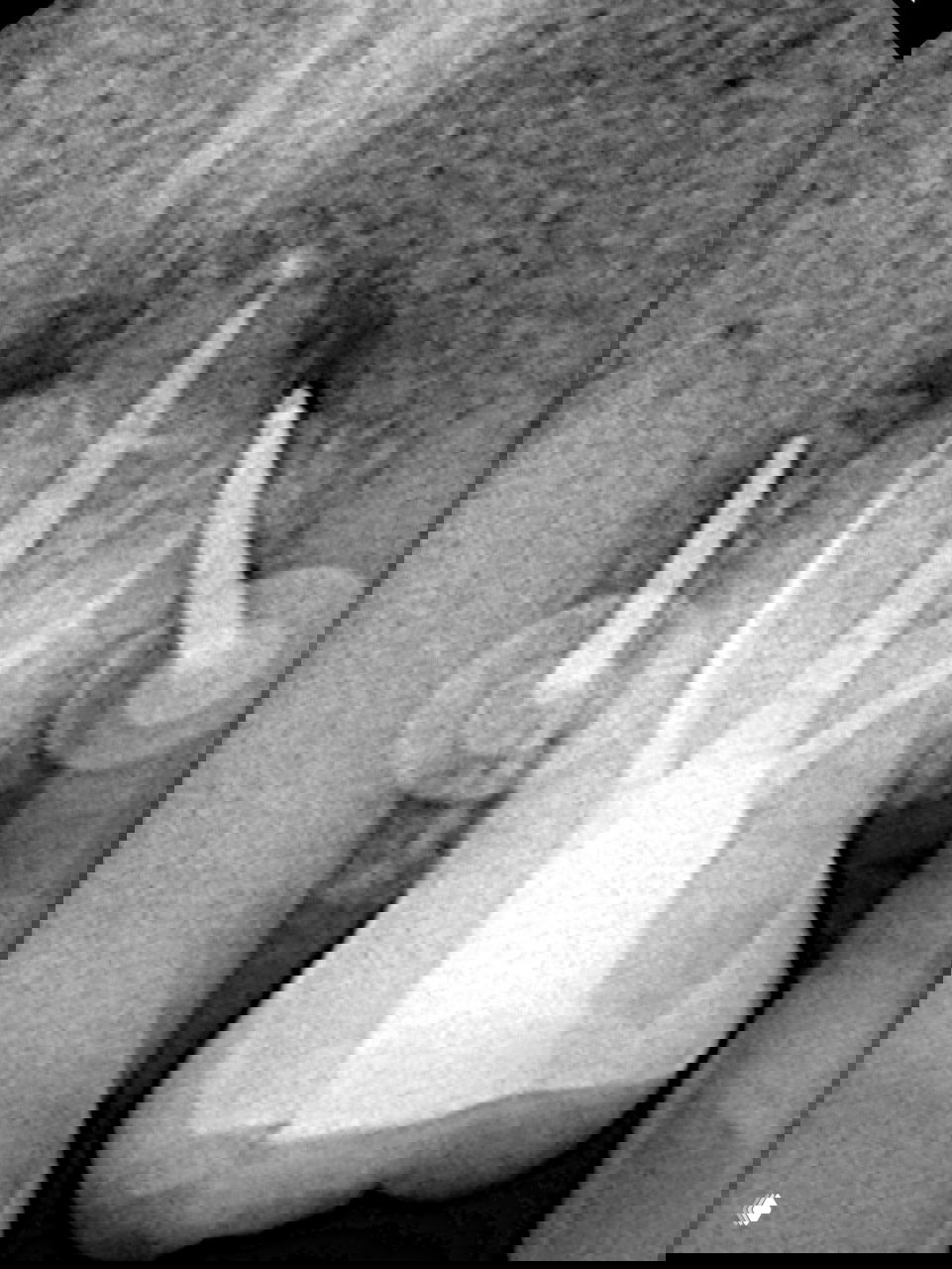 Контрольная рентгенограмма после пломбирования: видны заполненные корневые каналы и пломбировочный материал, апикальная обтурация оценена рентгенологически.