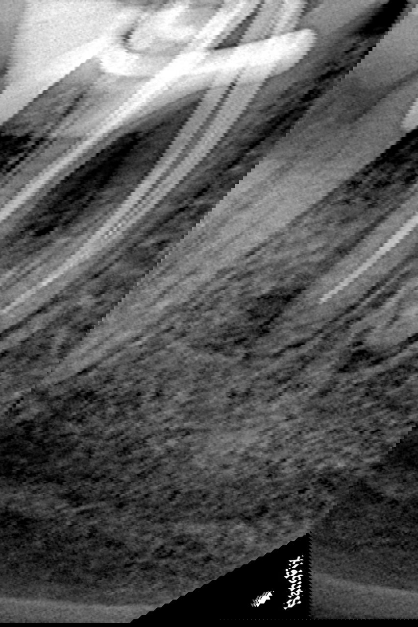 Рентгенография промежуточного этапа: каналы обработаны, видно размещение инструментов и зону вокруг предполагаемого обломка инструмента.