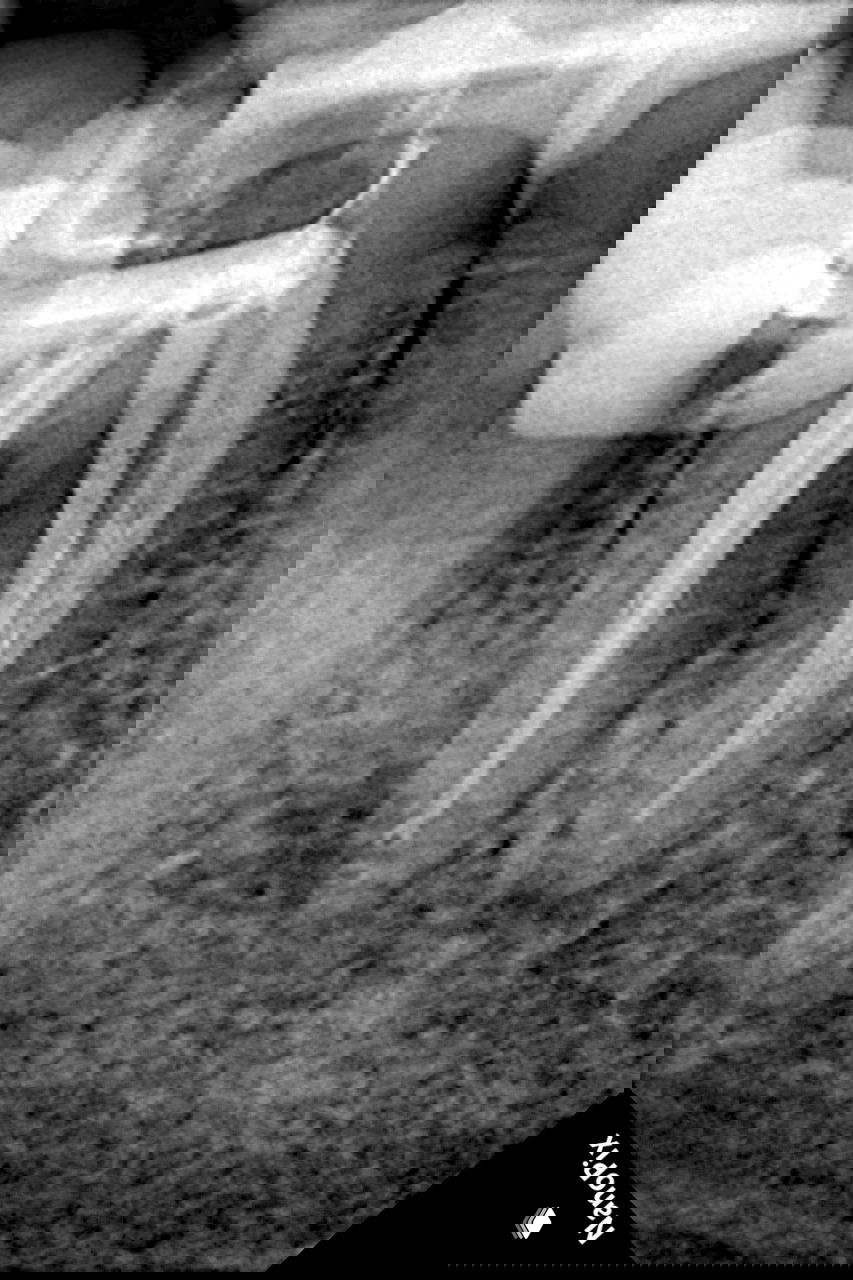 Финальная рентгенограмма после обтурации каналов: обтурация достигла рабочей длины, фрагмент инструмента остался под перешейком, прогноз без очага положительный.