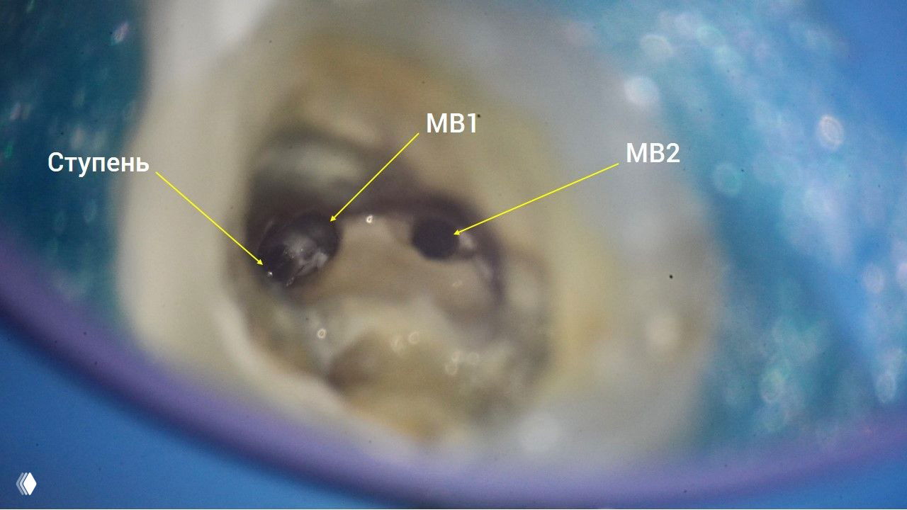 Поиск истинного хода МВ1 при слиянии с МВ2