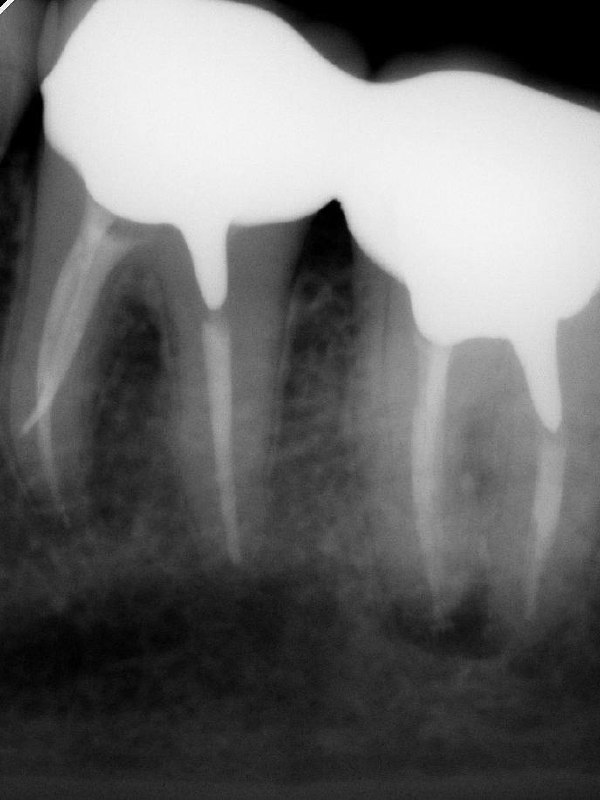 Культевая штифтовая вкладка — это всегда вопрос.