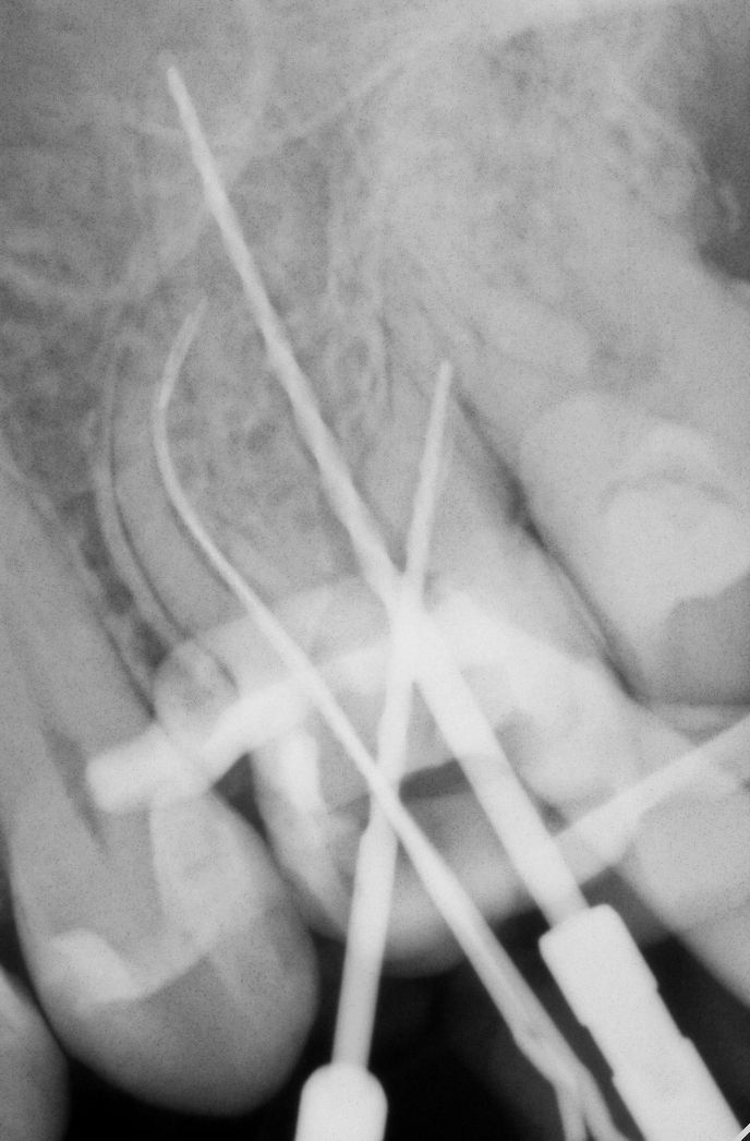 Рентген рабочего этапа эндодонтии: множественные файлы и измерительные штифты в корневых каналах, видны инструменты и коффердам.