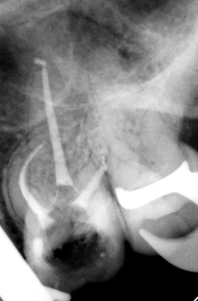 Рентген с инструментами в канале и выраженным периапикальным очагом у апекса зуба; демонстрация сложности клинического решения.