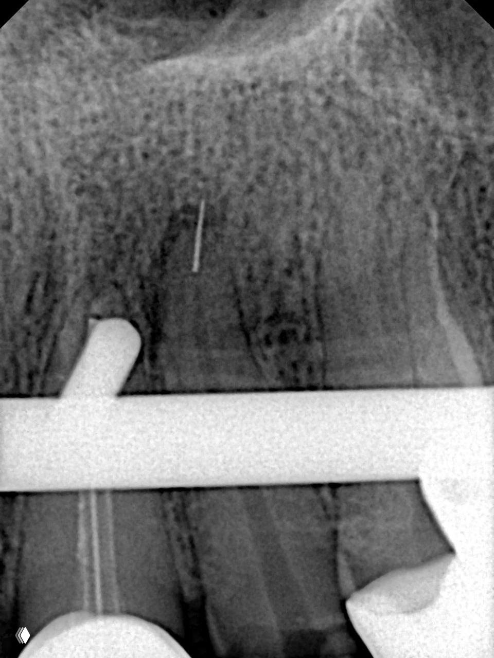 Байпас и извлечение обломка файла в апикальной части