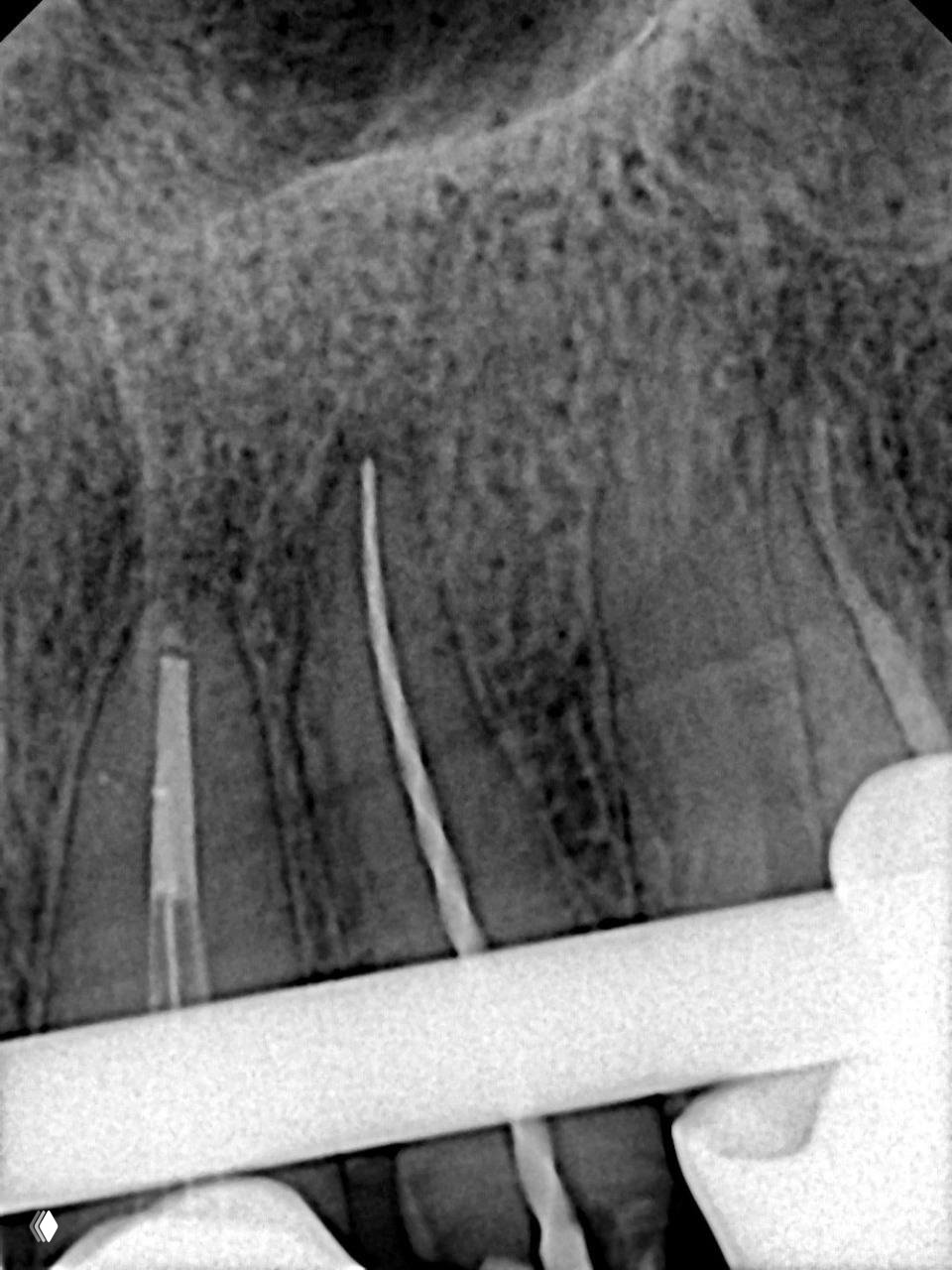 Дентальная рентгенография: виден рабочий файл и обломок в канале, отмечена внутренняя кривизна и расположение инструмента относительно апекса.