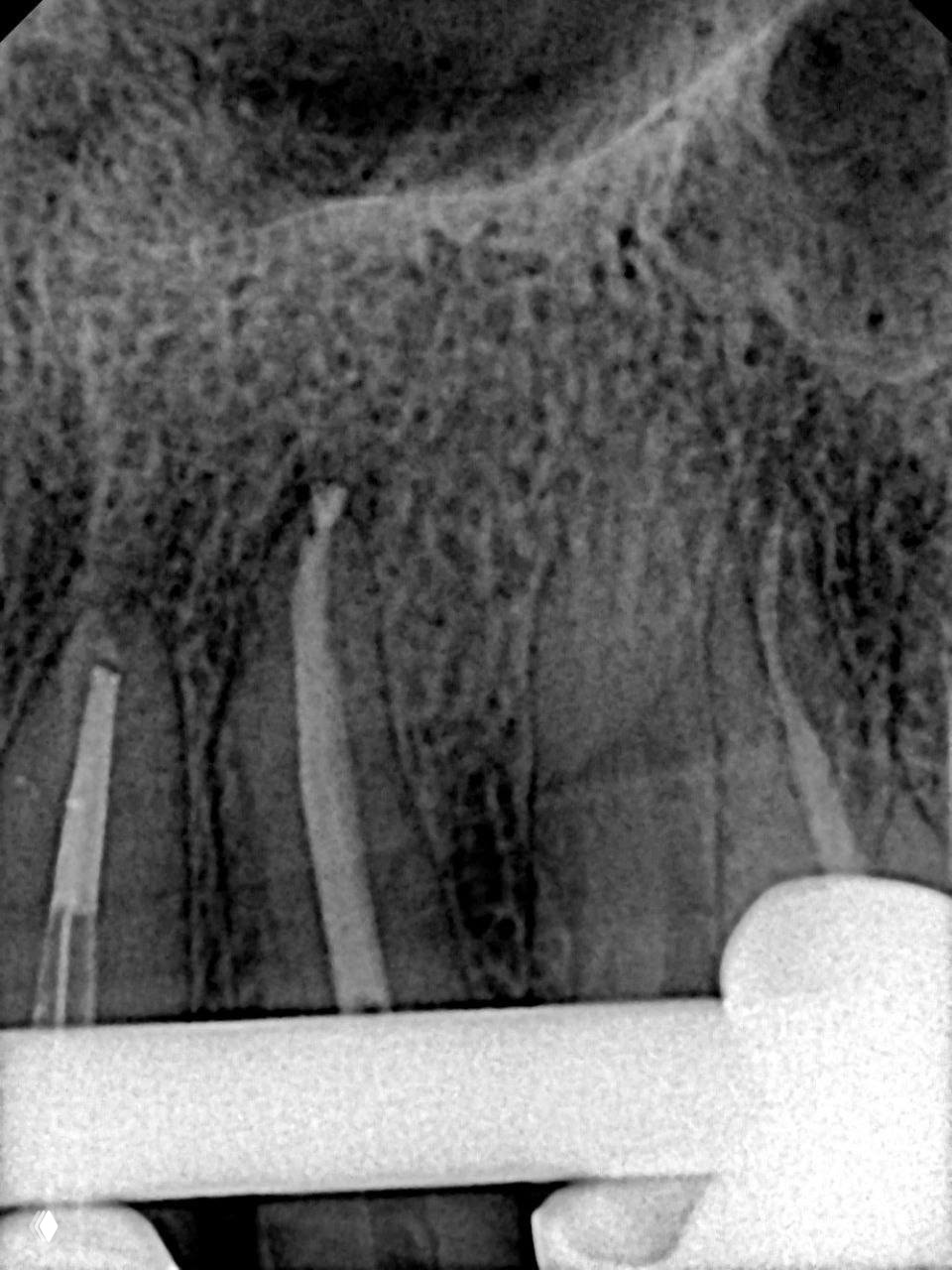 Рентген клинического случая: обломленный фрагмент файла в апикальной части, рядом видны машинные и ручные инструменты в корневых каналах.