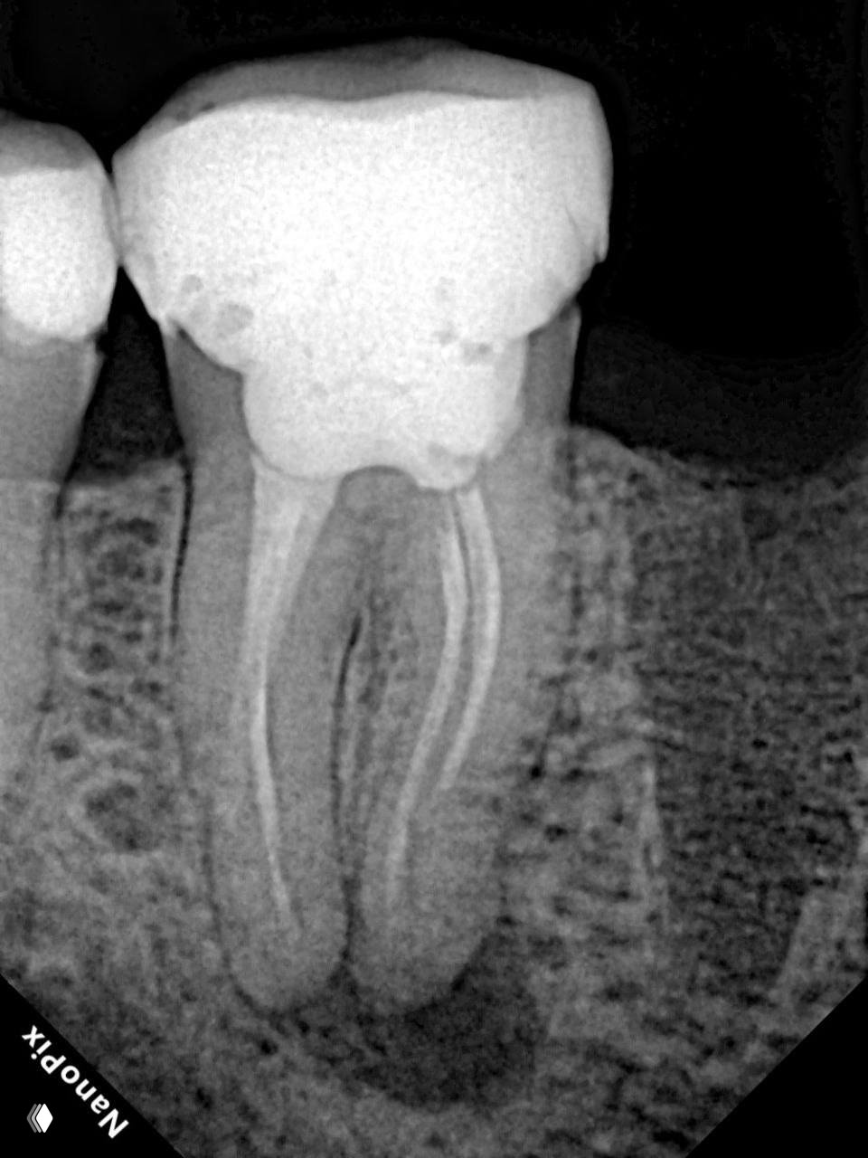 Перфорация закрыта, а зуб болел — клинический разбор