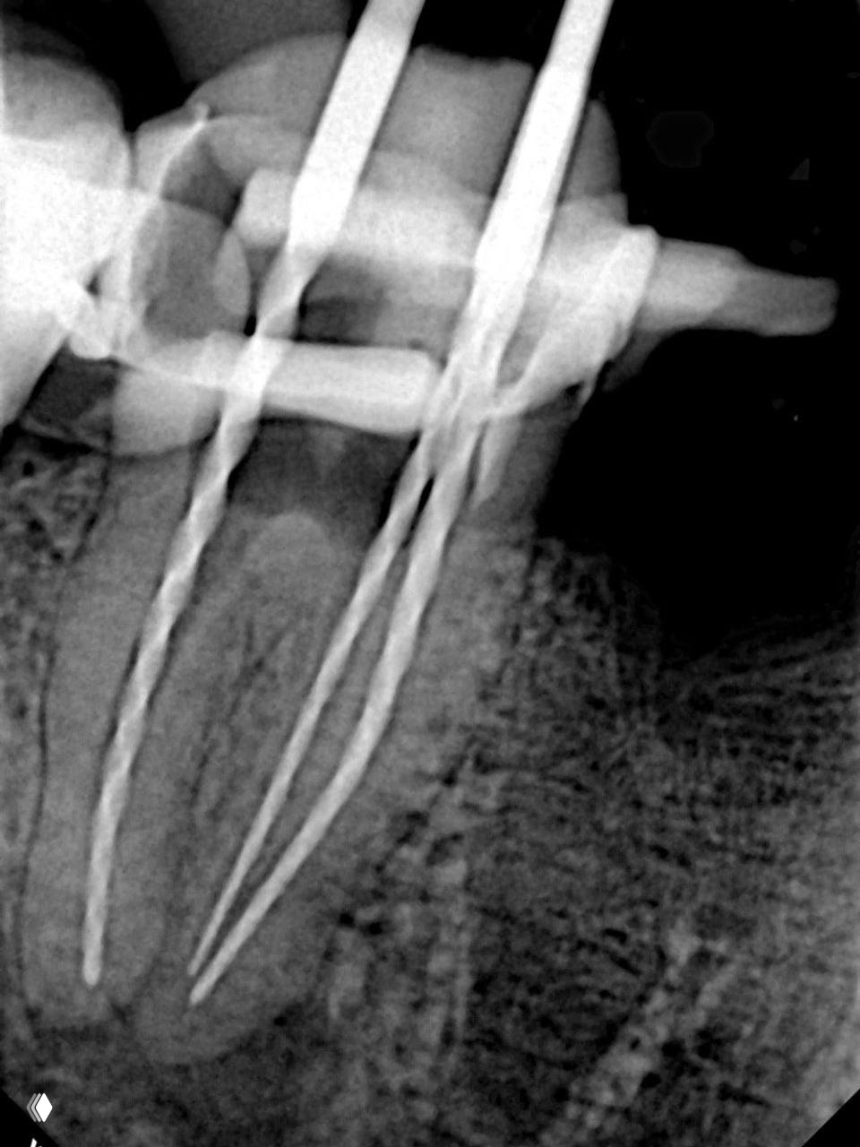 Интраоперационный рентген с рабочими инструментами в корневых каналах при деобтурации; видны файлы и подготовка каналов к повторной пломбировке.