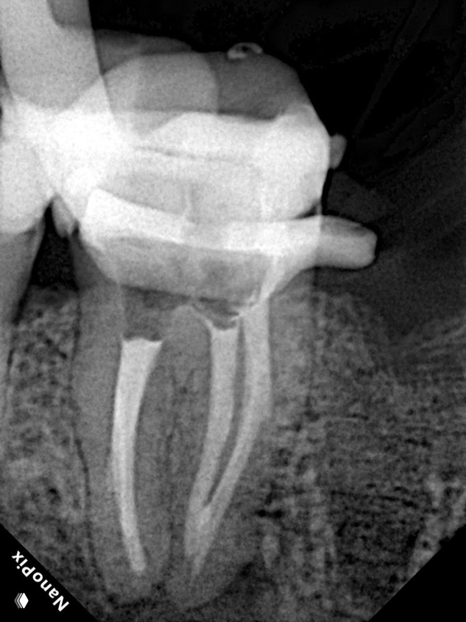 Контрольный рентген через 6 месяцев после повторного лечения: обтурация каналов по Шилдеру и вертикальная компакция, видимое уменьшение очага.