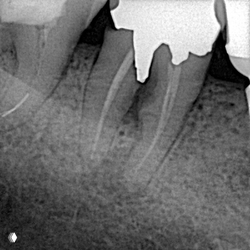 Какие перфорации всегда показаны к удалению