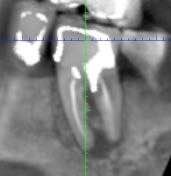 Кроп‑срез КТ/томограммы с разметкой перфорации и корневых каналов, демонстрирующий контакт перфорации с периодонтом и направление миграции эпителия.