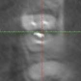 Коронально-аксиальный срез зуба с видимой зоной пародонтального кармана и расположением перфорации относительно зубо-десневой бороздки.