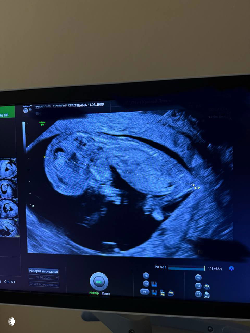 Снимок экрана аппарата УЗИ с чётким изображением плода, видны измерительные метки и элементы интерфейса монитора во время обследования беременности.