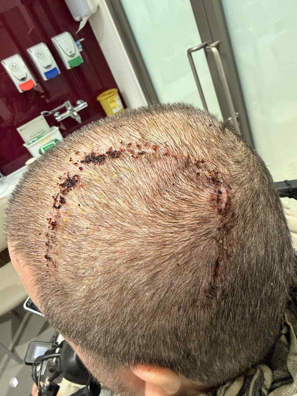Крупный план затылочной части головы с послеоперационными швами и корками крови на месте возможной установки импланта