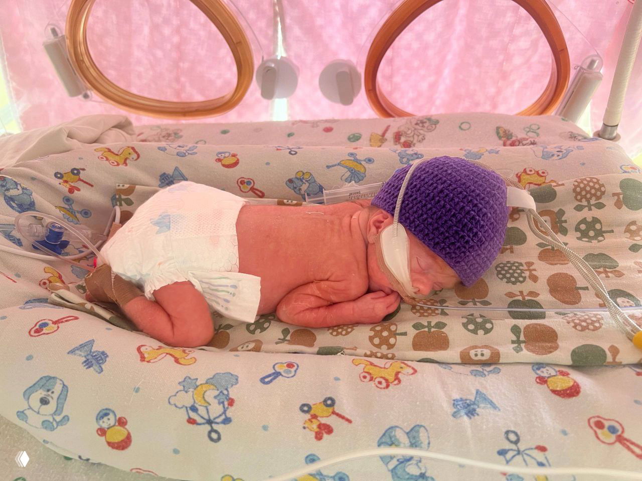 Крошечный недоношенный малыш в кувезе с кислородной поддержкой и фиолетовой шапочкой; снимок из отделения неонатологии, подчёркивающий хрупкость и борьбу за жизнь.