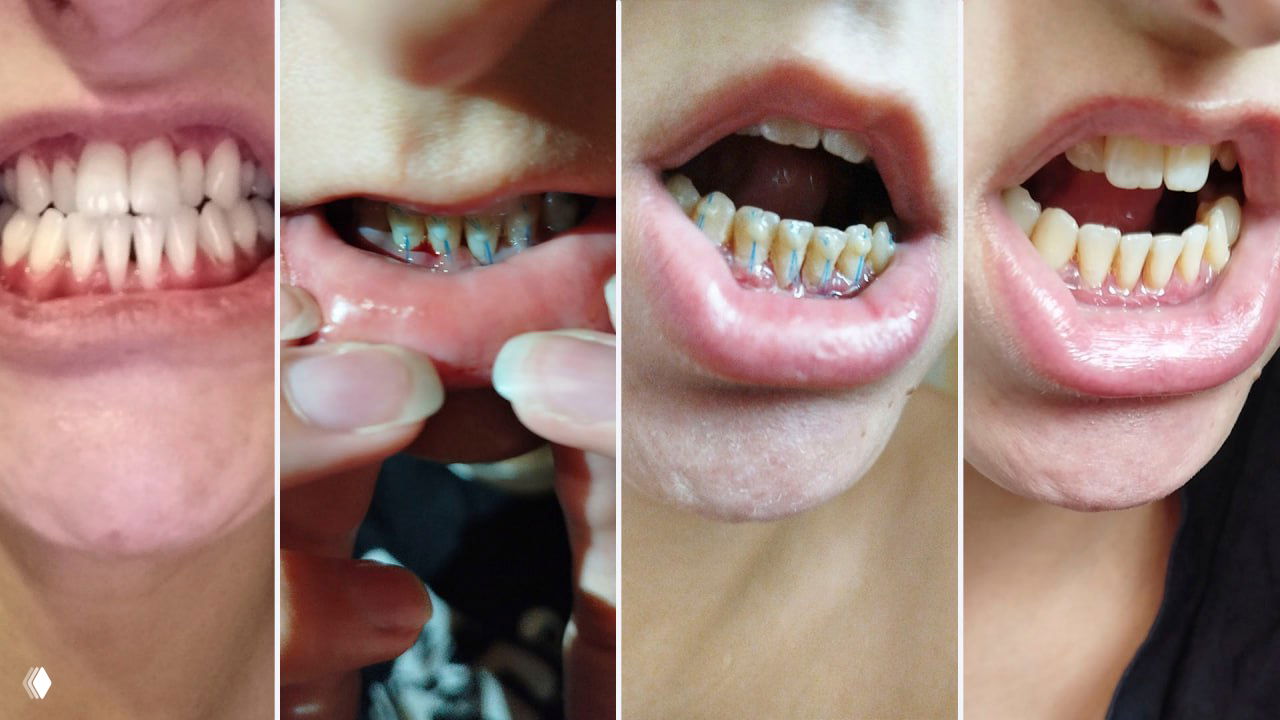 16 дней не чистила зубы, не ела и не шевелилась