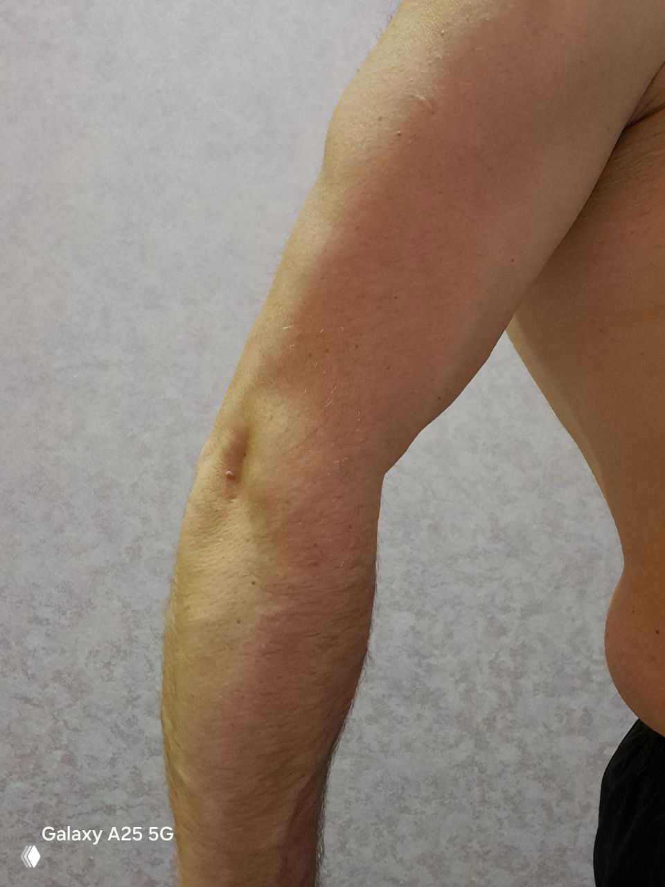 Крупный план предплечья мужчины с заметными венами и тонкой кожей, демонстрирующий степень исхудания и потерю подкожного жира.