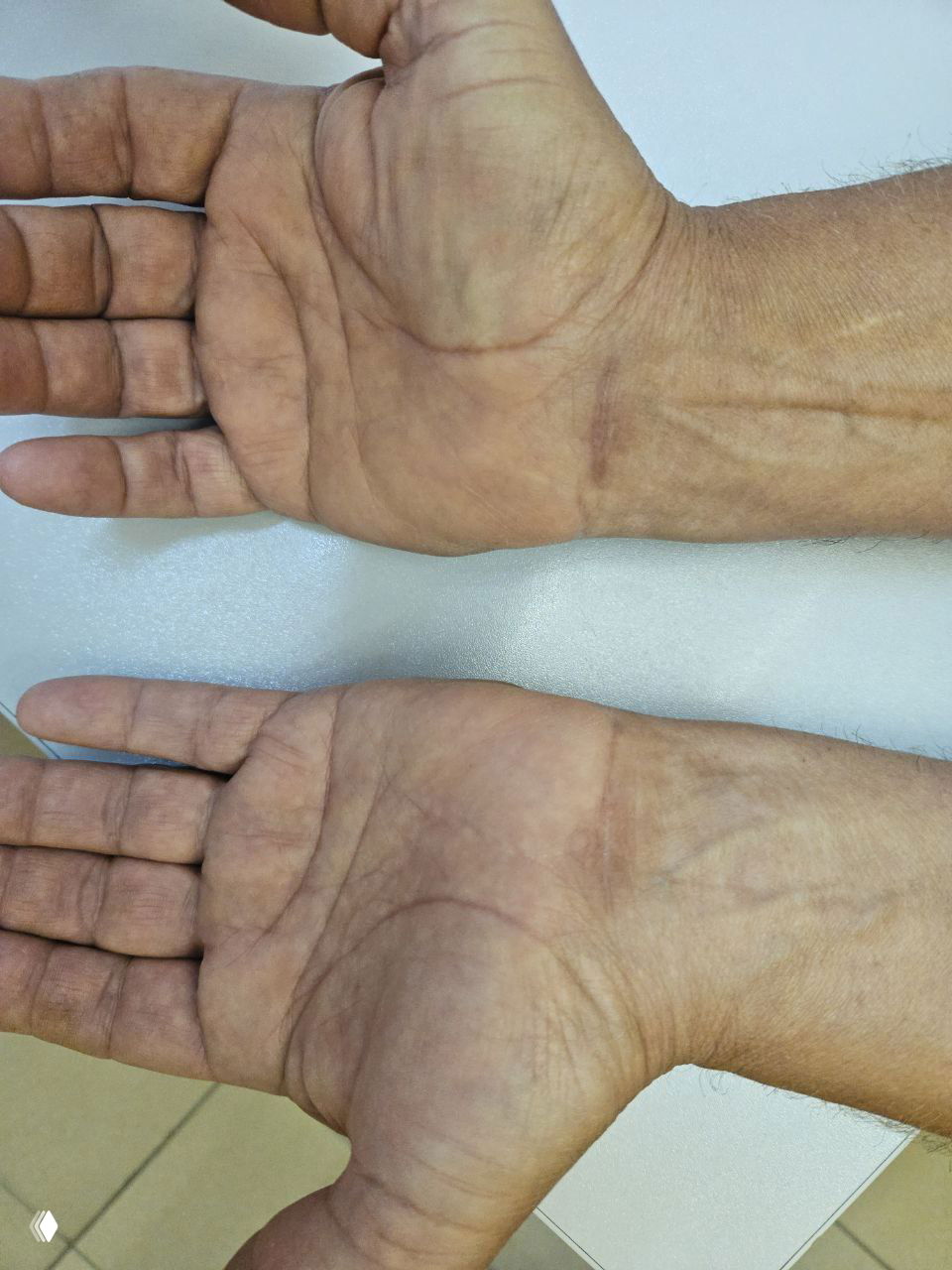 Эндоскопическая декомпрессия срединного нерва