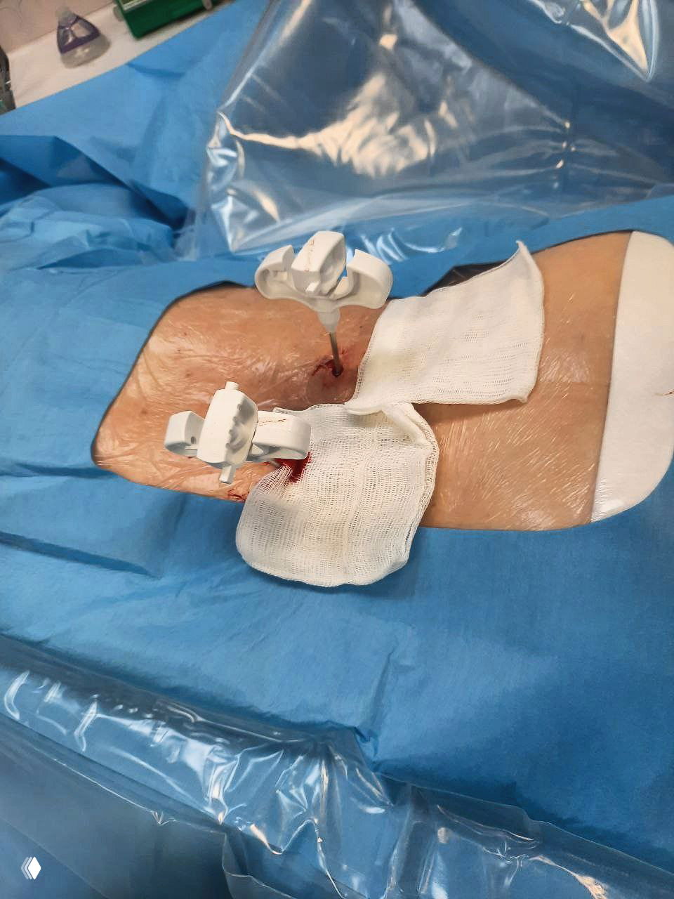 Установка игл Джамшиди перед вертебропластикой